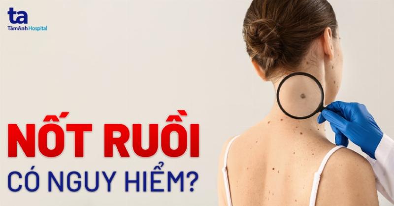 Nốt ruồi trên tay dưới góc nhìn khoa học: Cấu trúc da và nốt ruồi