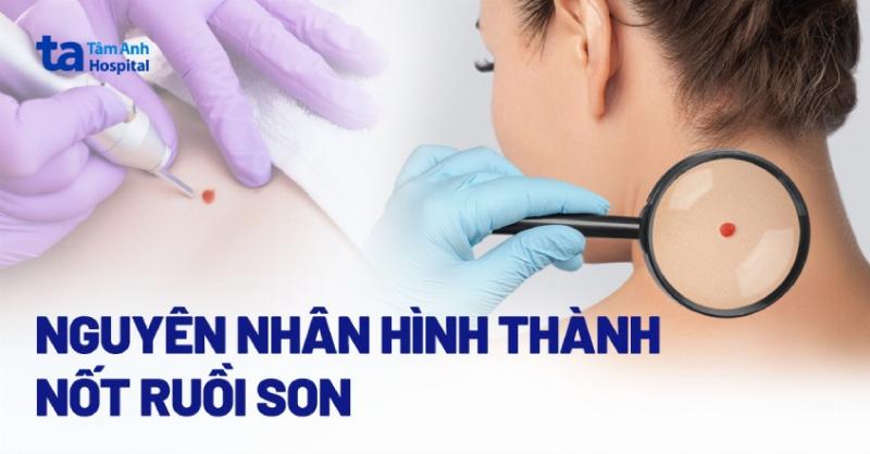 Nốt ruồi son nam giới